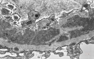 M,37y. | type I membranoproliferative glomerulonephritis (mesangiocapillary)